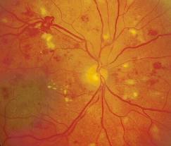 Diabetic Retinopathy 