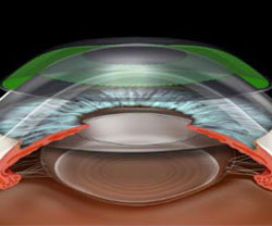 corneal refractive therapy CRT