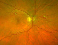 Optomap (diabetic retinopathy)