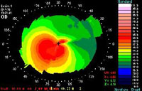 corneal topography 